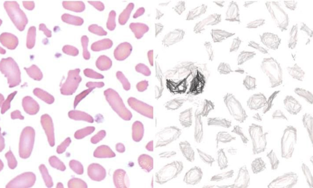 Ematologia pediatrica non oncologica